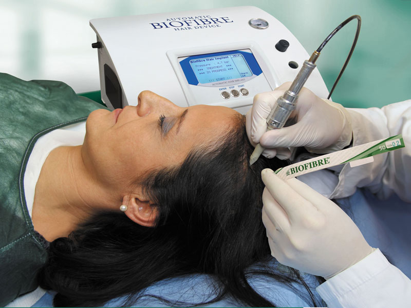 Extraction folliculaire FUE