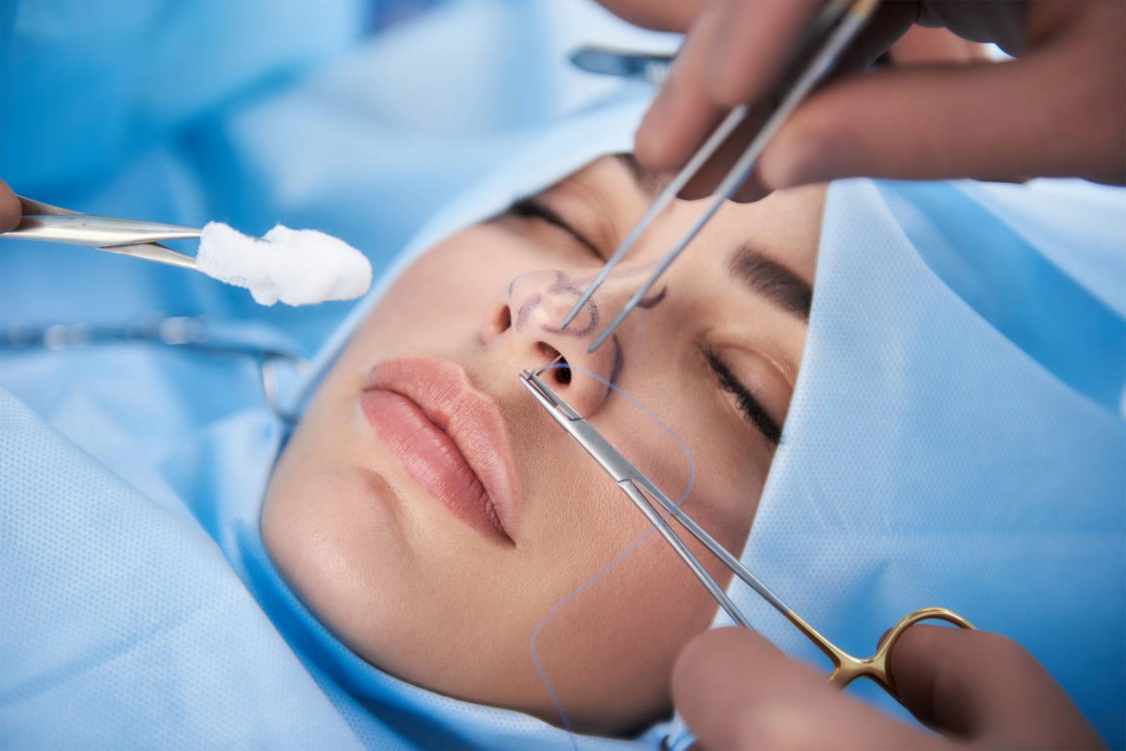 Rhinoplastie