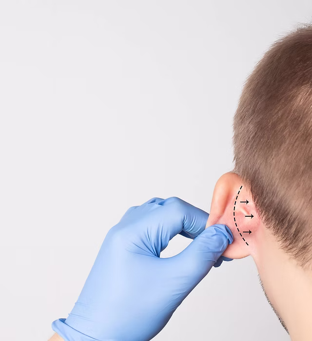 Otoplastie