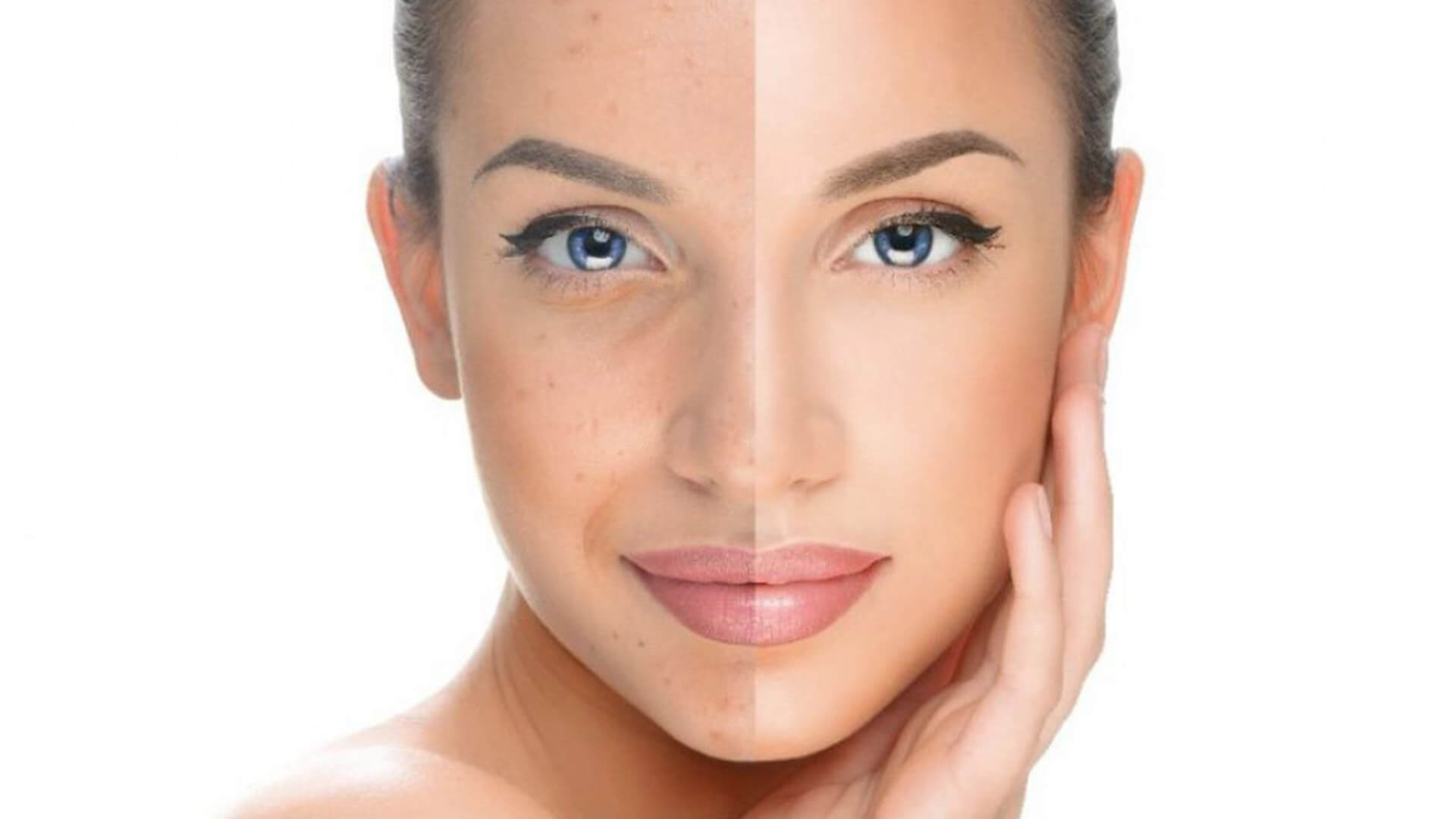 Dépigmentation de la peau