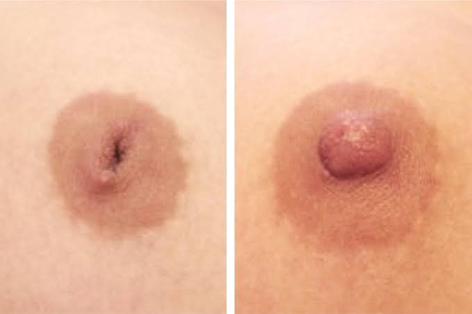 Correction des malformations