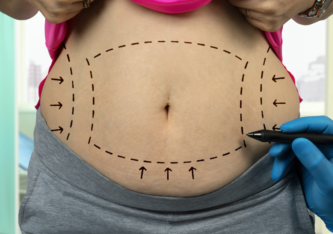 Abdominoplastie simple