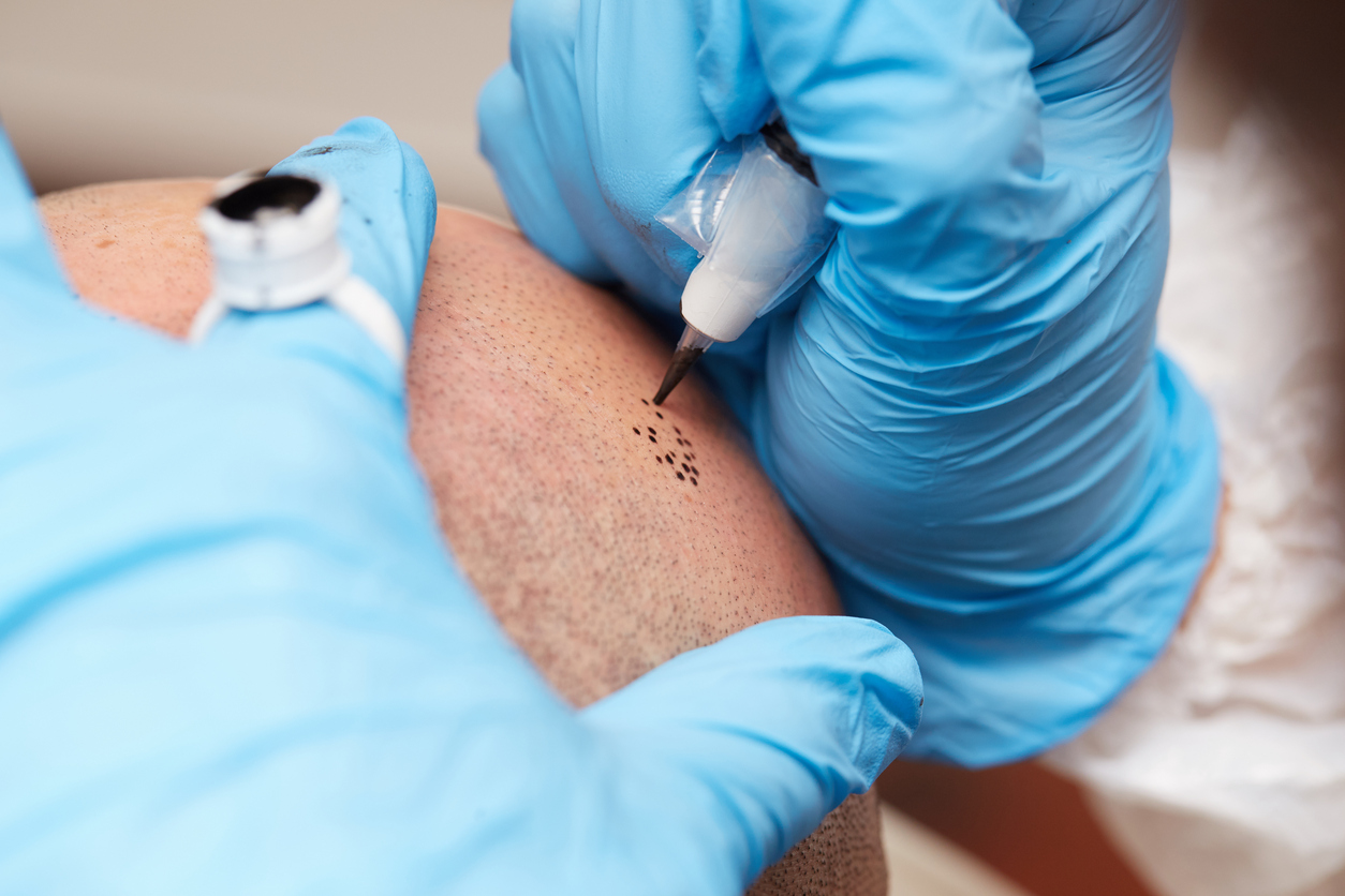 Tatouages esthétiques et médicaux